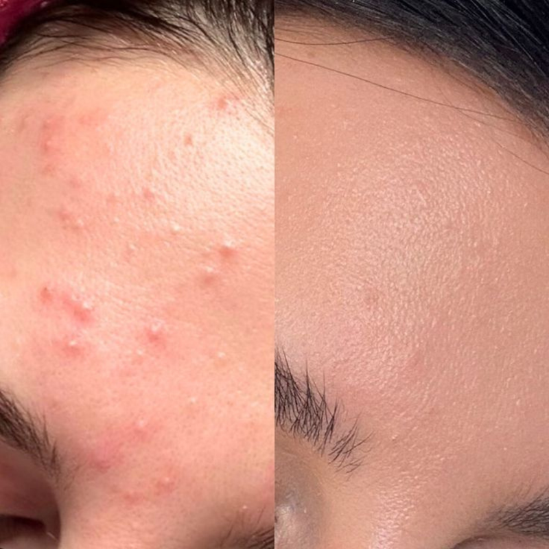 Intermediate Acne Program Acne Bootcamp in Middletown, CT | Clear Skin Program – The Bare Collection
